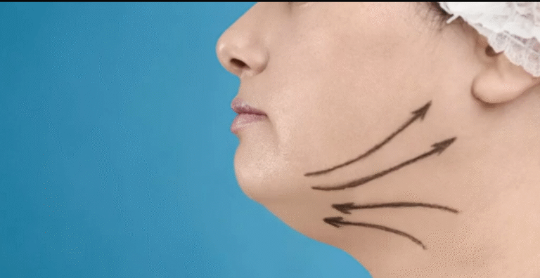Double Chin Removal In Dubai